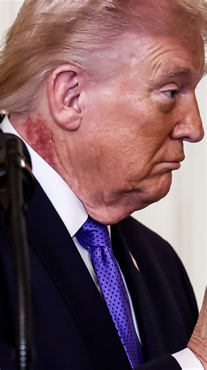 New rash seen on Trump's neck