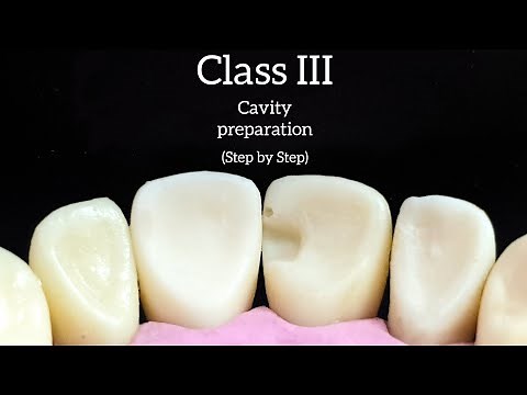 Class III cavity preparation step by step with explanation (upper incisor) - خطوة بخطوة مع الشرح