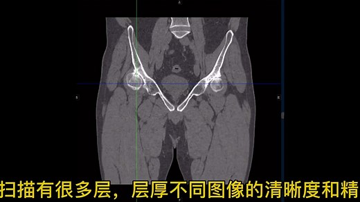 基于CT数据的三维重建技术