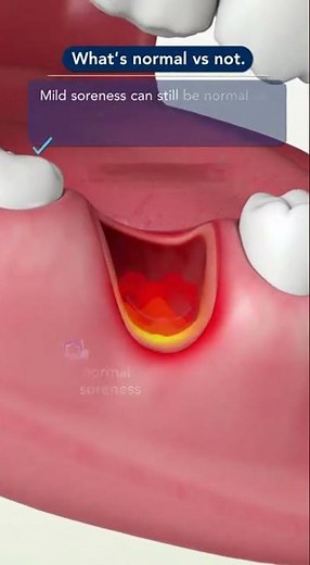 🦷 Still Having Pain 7 Days After a Tooth Extraction?
