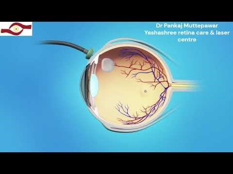 Macular hole surgery