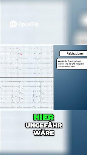 Breiter QRS-Komplex: EKG Analyse einfach erklärt!