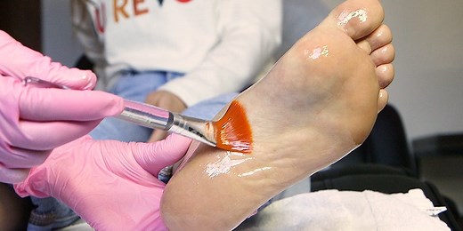 This chemical foot peel removes dead skin cell buildup through peeling calluses