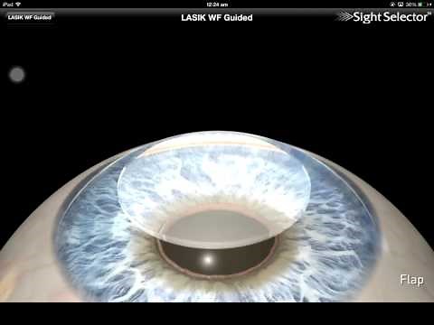 Lasik wavefront guided