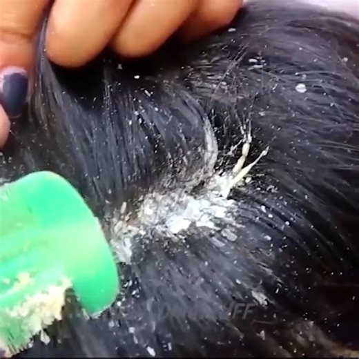 Dandruff Scratching ASMR on Reels