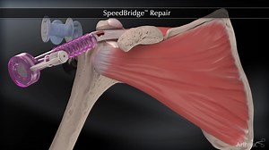 SpeedBridge™ Repair
