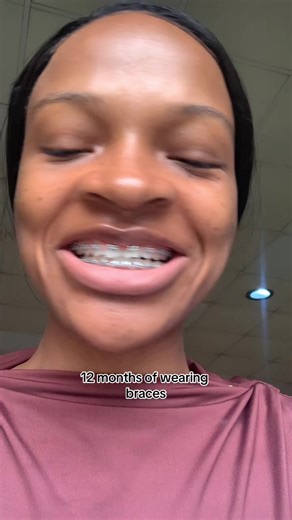 My Braces Journey: 12 Months of Transformation