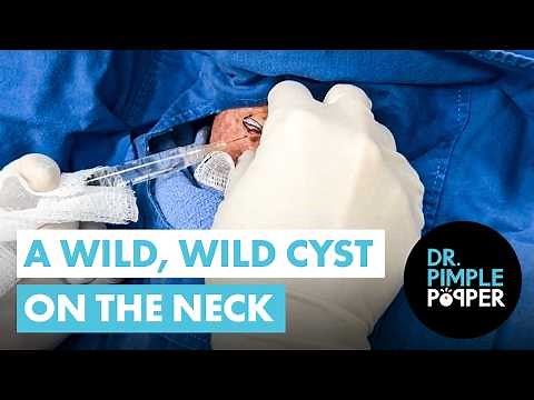 A Neck Cyst So Wild It Belongs in the Wild West!