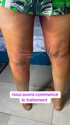 Toujours faire confiance au processus et tu dois témoigner, c’est une promesse. Vergeture Anti vergeture Stretch marks Traitement Vergeture dakar Senegal Rew Dindi rew Scat. #vergetures #rew #stretchmarks #vergeturetraitement #cicatrices