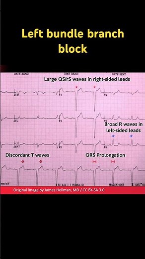Left bundle branch block (LBBB) ECG: Example 1