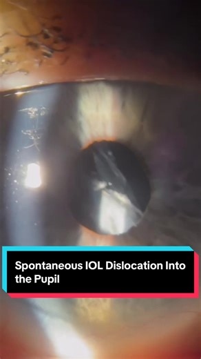 pontaneous IOL dislocation into the pupil. No trauma, the capsule suddenly lost stability and the artificial lens slipped forward. #IOLdislocation #Ophthalmology #EyeHealth #MedicalTok #eyedoctor