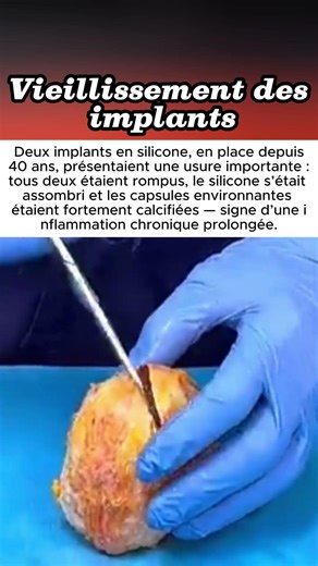 Vieillissement des implants