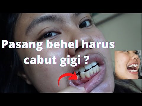 ALASAN GIGI GERAHAM AKU DI CABUT SEBELUM PASANG BEHEL !! |CABUT GIGI GERAHAM BAWAH SAAT PASANG BEHEL