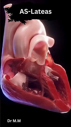 Aortic Stenosis Murmur Explained (The Harsh Systolic Ejection Sound)