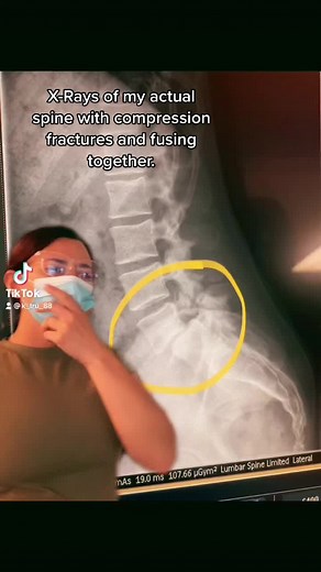 Understanding Compression Fractures in the Spine