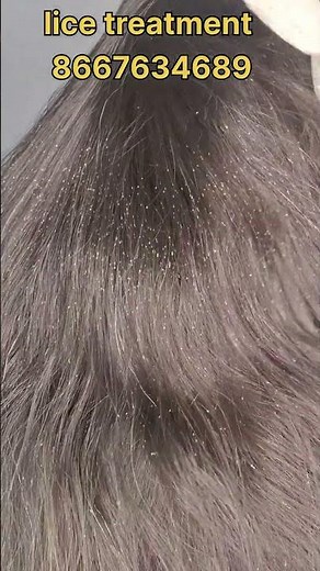 How to remove nits and lice treatment #nits #hair #headlice #haircareliceremoval #lice #peenu #eeru
