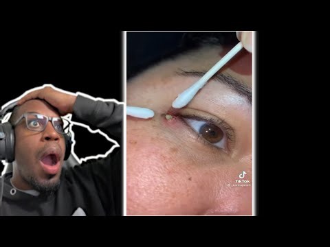 The BIGGEST PIMPLES Compilation from Tik Tok! 😱🌋
