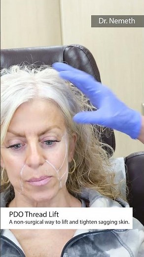 PDO Thread Lift procedure