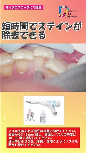 [How to deal with patients who are prone to staining: Case 2] Dental knowledge you can't ask now....