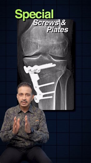 Pankaj Walecha on Instagram: "Recovery Time & Rehab After High Tibial Osteotomy 🦵 High Tibial Osteotomy (HTO) is a knee-saving surgery that realigns your bone to take pressure off the arthritic side of the knee. 🛠 How it works: The bone is cut, straightened, and fixed with a special plate & screws — giving stability and strength while it heals. ⏳ Recovery Timeline Same day: Many patients can start walking with support 2–3 weeks: Most can leave the walker or crutches 2–3 weeks: Office-goers can