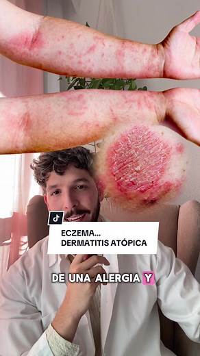 Dermatitis Atópica: Manejo y Tratamientos Efectivos