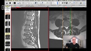 What does a pinched nerve look like on MRI? Chiropractic Clinical Companion: Evaluating Foraminal Stenosis in the Lumbar Spine on MRI. | The Evidence Based Chiropractor