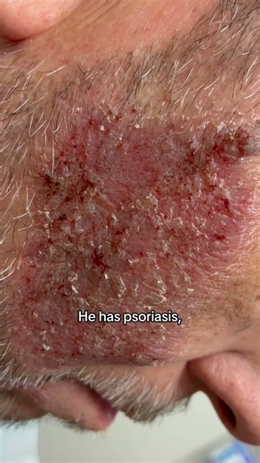 Dermatologist with 50 years of experience discusses treatment for large scab on man's face👨🏻‍⚕️