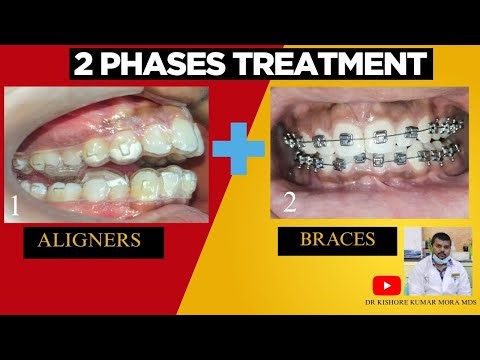 Mandibular Advancement and Aligner Therapy Leads to SHOCKING Braces Results#Dr kishore kumar mora 