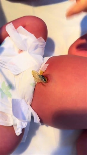 How to Clean a Newborn's Umbilical Cord Safely! 👶✨