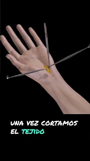 Operación síndrome de túnel carpiano.