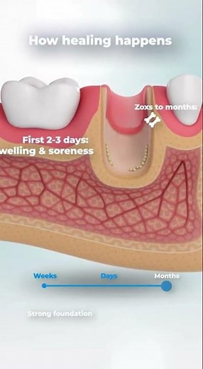 🦷 What Is Recovery Like After a Tooth Extraction With a Bone Graft?