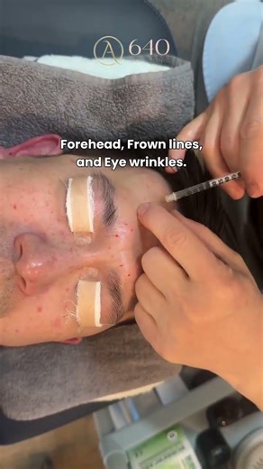 Forehead, frown, and eye lines plus pigmentation can make the face look tired over time. #AntiAging