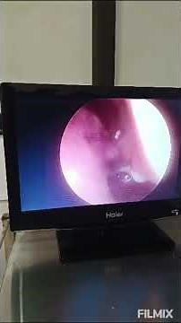 Rhinolith in a 40 yr old male. Endoscopic removal.