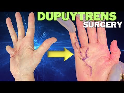 Dupuytren viking's hand correction surgery before and after