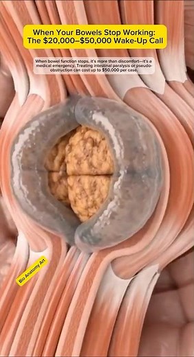 When Your Bowels Stop Working: The $20,000–$50,000 Wake-Up Call