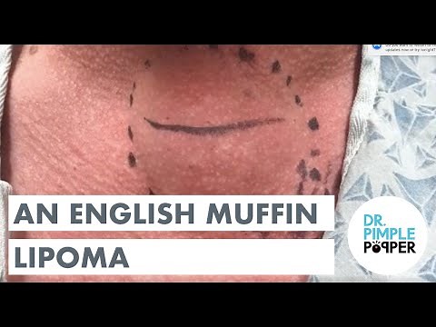 An English Muffin Lipoma