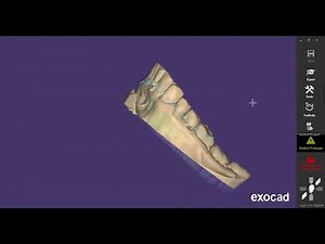 DISEÑO DE GUIA QUIRURGICA PARA IMPLANTES DENTALES CON EXOPLAN