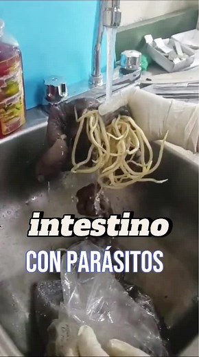Obstrucción intestinal por parásitos: síntomas y tratamientos