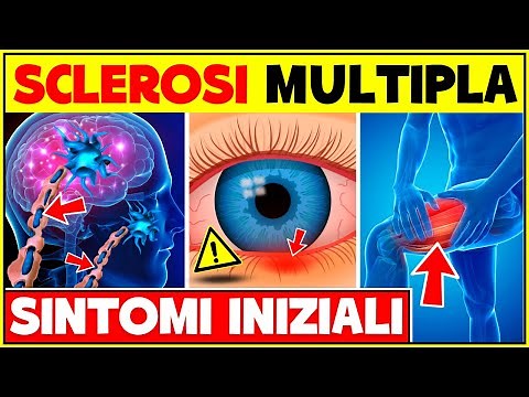 Early Signs and Symptoms of Multiple Sclerosis How to Recognize Multiple Sclerosis