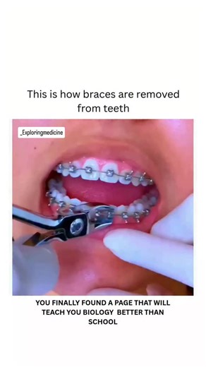BIOLOGY | HEALTH | MEDICAL on Instagram: "Braces are removed by an orthodontist using a special plier to gently pop off each bracket. After removing the archwire and all brackets, the orthodontist uses a dental handpiece to safely polish away any remaining adhesive from the tooth surface. The final step involves taking impressions for retainers, which are necessary to keep teeth in their new positions Dm for ctedit or removal 🙏 For educational purposes only........ #viral #insane #bio #B