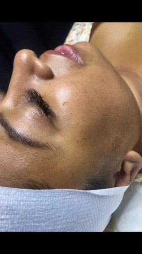 Dermaplaning Facial✨ Kiss your Peach Fuzz Goodbye withour dermaplaning Facial. Dermaplaning is a manual exfoliation technique, we use acustom blade to remove the surface debris for a better product absorption #fypシ #fyp #esthetician #facialtreatment #facial #trini_tiktoks #foryourpage #tiktoker #satistifying #esthetician