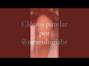 Clônus patelar/ patellar clonus