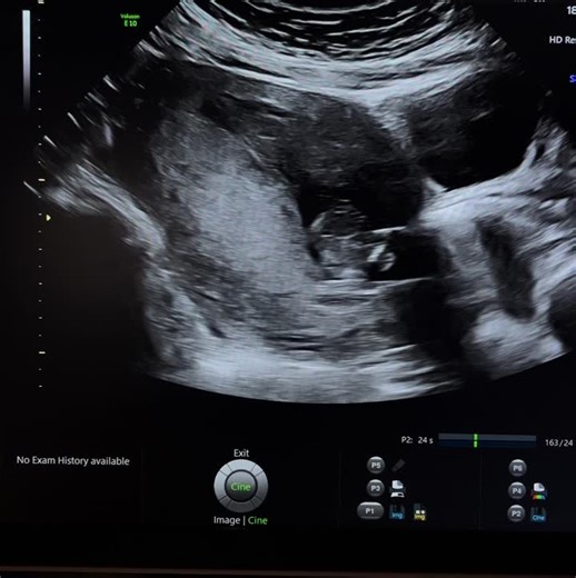 Understanding Chorionic Villus Sampling (CVS) for Genetic Disorders | Rana Al-salmei posted on the topic | LinkedIn