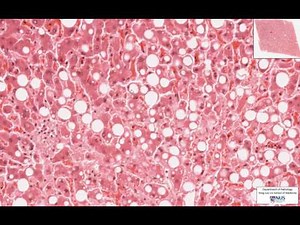 Liver Fatty Change (Intracellular accumulations) - Microscopy