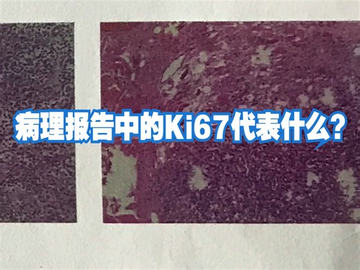 医学科普：病理报告中的Ki67代表什么？