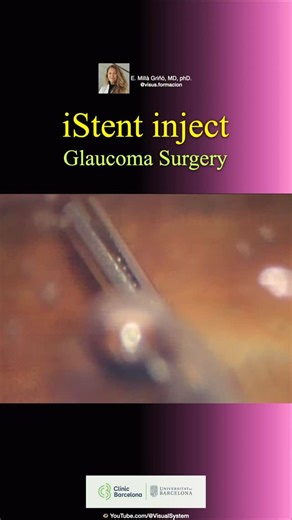 Visual System on Instagram: "iStent inject. Glaucoma Surgery. E. Miilà Griñó, MD, PhD. @dr_elenamilla The iStent inject is a microscopic, titanium implant used in Minimally Invasive Glaucoma Surgery (MIGS) to lower intraocular pressure (IOP) for patients with primary open-angle glaucoma, pigmentary glaucoma, or pseudo-exfoliative glaucoma. It works by creating tiny bypasses through the trabecular meshwork to allow aqueous humor to flow out, reducing pressure, and often decreasing the need for gl