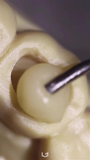 Posterior Composite Restoration: Indirect Technique Explained