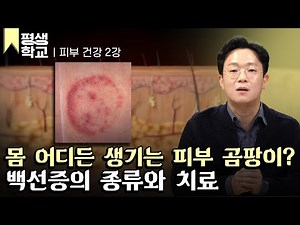 [#EBS Lifelong School] Lesson 2: Ringworm, a Fungus on the Skin│Im Jae-woo's Friendly Doctor - Sk...