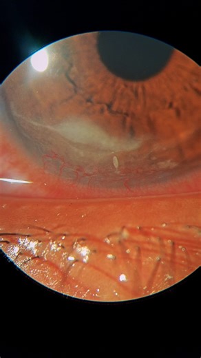 MT eye care | Comment your diagnosis ? 🛑 Clinic case Patient facing redness , irritation since 1 week H/O traumatic injury by paddy straw Vision 6/6... | Instagram