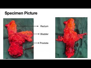 474 Robotic Total Pelvic Exenteration Dr Ankit Sharma